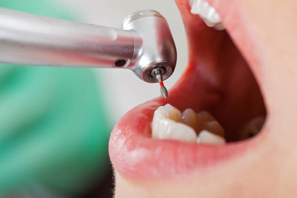 Best Emergency Tooth Extraction in Marion, OH